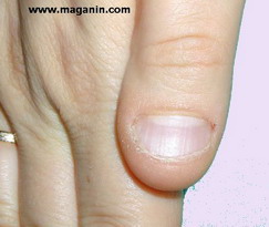 الأظافر Onychophagia onychophagia2.jpg