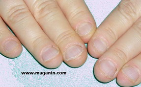 الأظافر Onychophagia onychophagia3.jpg