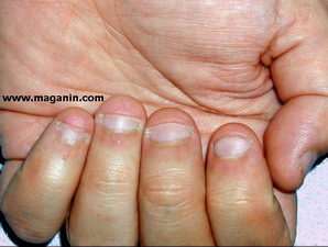 الأظافر Onychophagia onychophagia6.jpg