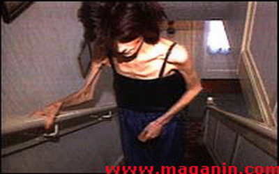    Anorexia Nervosa